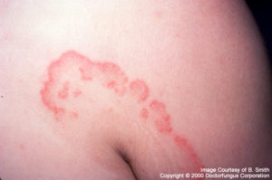 Tinea corporis Information