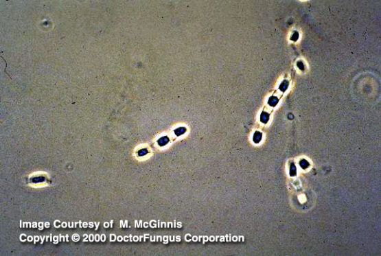 Coccidioidomycosis - Doctor Fungus