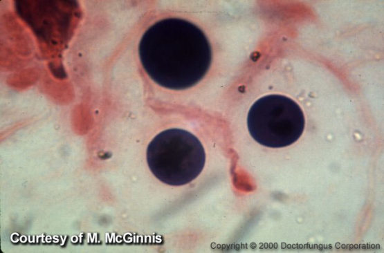 Cryptococcosis Doctor Fungus