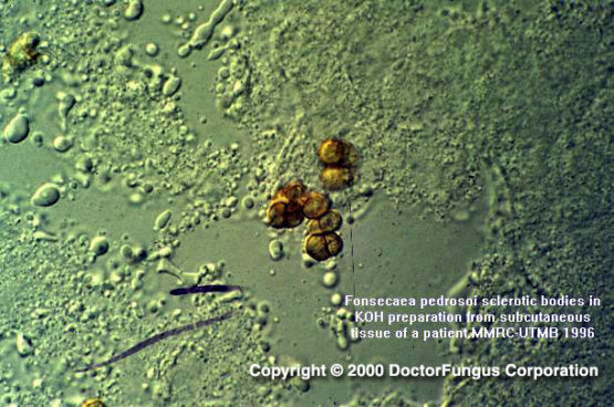 Fonsecaea Species - Doctor Fungus