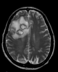 Figure 2 Cranial MRI scan (axial T2W TSE) showing two lesions with ...