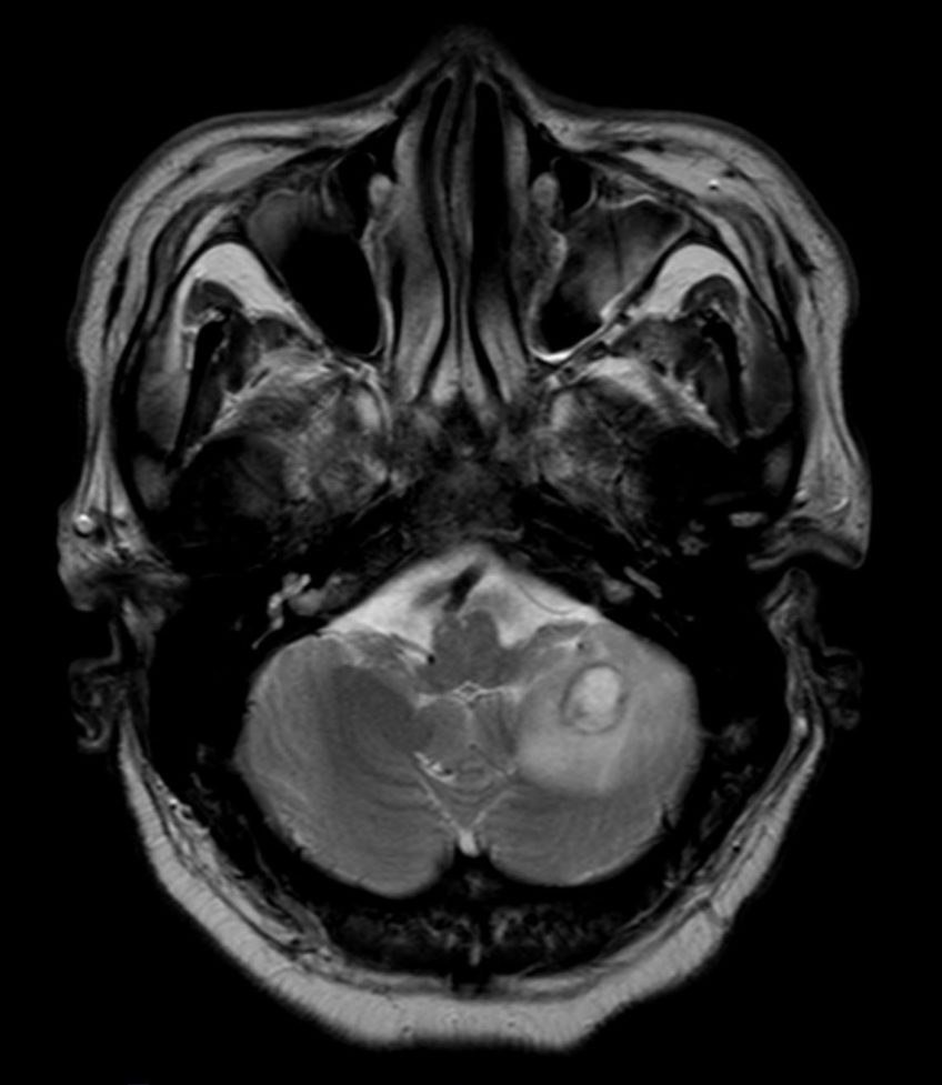 Figure 3 cranial MRI scan (axial T2W TSE) showing a single lesion in ...