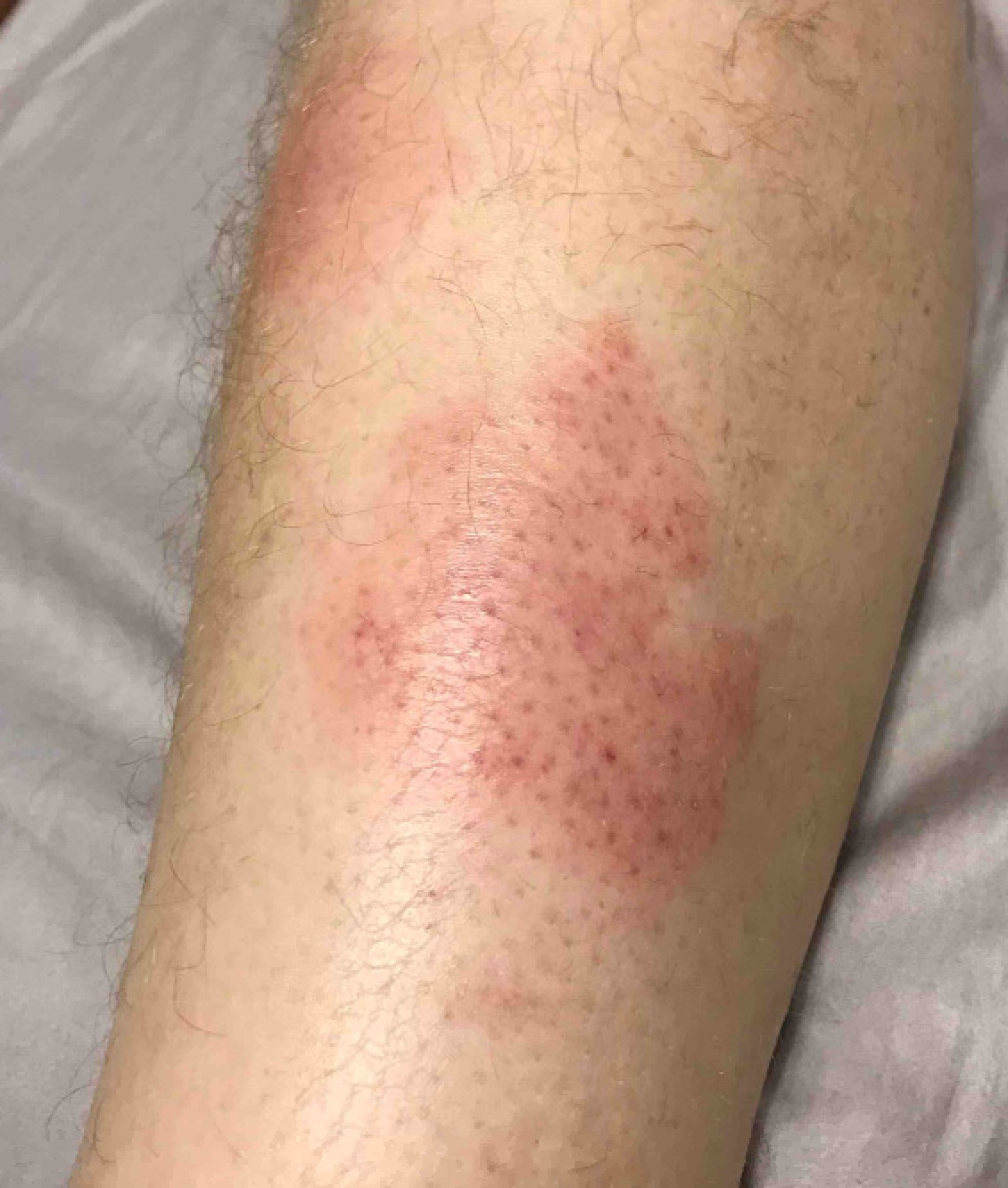 Collection 96+ Pictures Red Rash On Lower Legs Above Ankles Photos Full